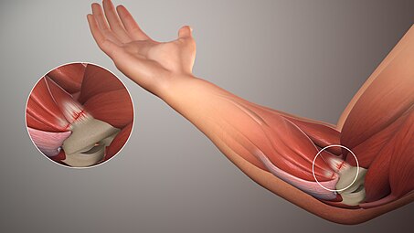 Golfers Elbow